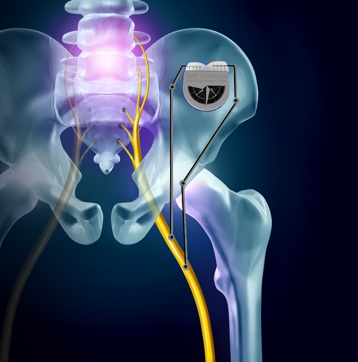 Sciatica Pain